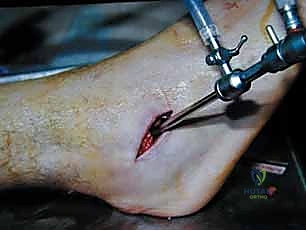 تفاصيل جراحية دقيقة