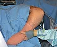 صورة توضيحية لـ تنظير مفصل المرفق لعلاج خشونة المفاصل التنكسية: دليل شامل للمرضى مع الأستاذ الدكتور محمد هطيف