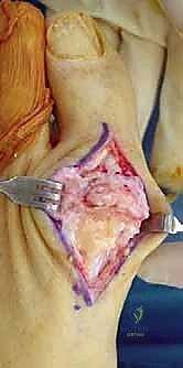 Illustration of metatarsophalangeal joint hemiarthroplasty - Dr. Mohammed Hutaif