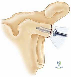 صورة تظهر المريض أثناء مراحل العلاج الطبيعي واستعادة الحركة
