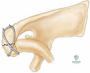توضيح لعملية الرد المفتوح وإرجاع الشظايا العظمية