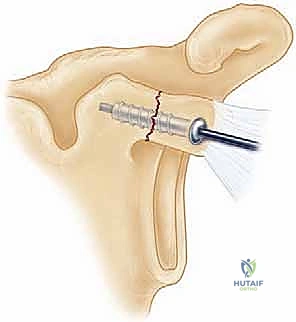 جراحة كسور لوح الكتف غير المفصلية: دليل شامل لاستعادة حركة الكتف مع الأستاذ الدكتور محمد هطيف