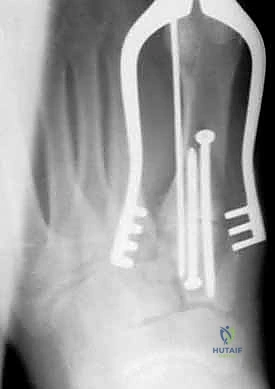 إصابة ليزفرانك: دليل شامل للتشخيص والعلاج الجراحي الدقيق في صنعاء مع الأستاذ الدكتور محمد هطيف