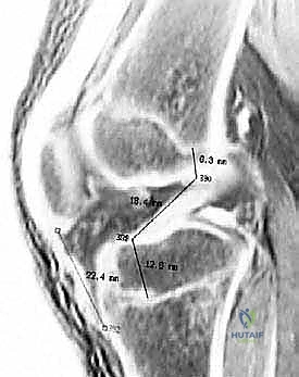 صورة رنين مغناطيسي سهم رفيع يشير إلى نمط كدمة عظمية مميزة لإصابة الرباط الصليبي الأمامي الحادة
