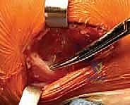 صورة أشعة سينية أثناء الجراحة لتأكيد موقع الأنفاق العظمية