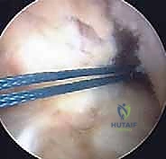 رؤية بالمنظار الجراحي 4K لمفصل الركبة