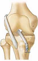 صورة توضيحية لـ إعادة بناء الرباط الصليبي الأمامي عند الأطفال والمراهقين: نهج يحافظ على صفائح النمو