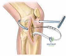 تمرير الطعم الوتري داخل الركبة بتقنية تحافظ على الغضروف النمائي