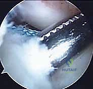 صورة توضيحية لـ إعادة بناء الرباط الصليبي الأمامي عند الأطفال والمراهقين: نهج يحافظ على صفائح النمو