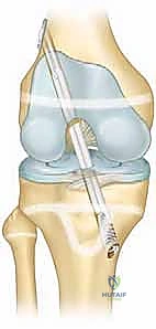 Illustration of skeletally immature patients - Dr. Mohammed Hutaif