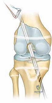 استخراج وتر العضلة الرباعية لاستخدامه كطعم