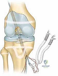 صورة توضيحية لـ إعادة بناء الرباط الصليبي الأمامي عند الأطفال والمراهقين: نهج يحافظ على صفائح النمو