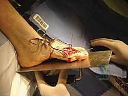 الأستاذ الدكتور محمد هطيف يوضح الأشعة السينية لحالة إبهام القدم المتصلب