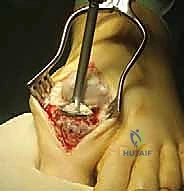 صورة توضيحية لـ تثبيت مفصل إبهام القدم الكبير: الحل الجراحي المتقدم لإبهام القدم المتصلب مع الأستاذ الدكتور محمد هطيف