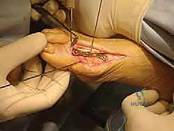 تثبيت مفصل إبهام القدم الكبير: الحل الجراحي المتقدم لإبهام القدم المتصلب مع الأستاذ الدكتور محمد هطيف