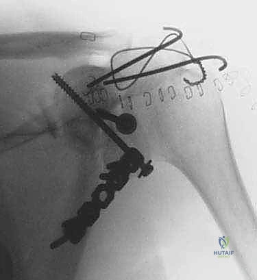 صورة توضيحية لـ جراحة تثبيت كسور لوح الكتف داخل المفصل: دليل شامل للمرضى مع الأستاذ الدكتور محمد هطيف