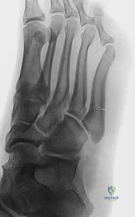 Illustration of fixation of jones - Dr. Mohammed Hutaif