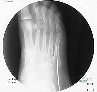 Masterclass: Percutaneous Intramedullary Screw Fixation for Jones Fractures