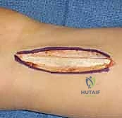 تصنيف ليختمان لمرض كينبوك