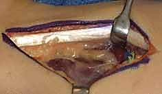 التشخيص الإشعاعي لمرض كينبوك