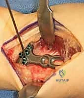 الأعراض السريرية لمرض كينبوك