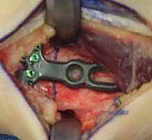 صورة توضيحية لـ عملية تقصير عظم الكعبرة لعلاج مرض كينبوك: دليل شامل للمرضى مع الأستاذ الدكتور محمد هطيف