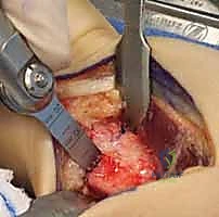 صورة توضيحية لـ عملية تقصير عظم الكعبرة لعلاج مرض كينبوك: دليل شامل للمرضى مع الأستاذ الدكتور محمد هطيف