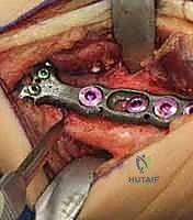 Illustration of negative ulnar variance - Dr. Mohammed Hutaif