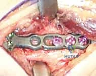 صورة طبية: عملية تقصير عظم الكعبرة لعلاج مرض كينبوك: دليل شامل للمرضى مع الأستاذ الدكتور محمد هطيف