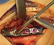 صورة توضيحية لـ عملية تقصير عظم الكعبرة لعلاج مرض كينبوك: دليل شامل للمرضى مع الأستاذ الدكتور محمد هطيف