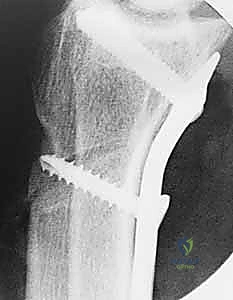صورة طبية: عملية تقصير عظم الكعبرة لعلاج مرض كينبوك: دليل شامل للمرضى مع الأستاذ الدكتور محمد هطيف