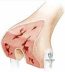 الأعراض السريرية لفشل المفصل