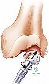 تخطيط جراحي لاستبدال الفخذ البعيد