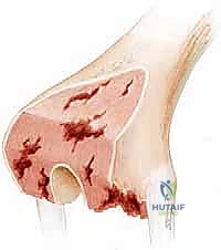 استبدال الفخذ البعيد في مراجعة مفصل الركبة الكلي: دليل شامل للمرضى مع الأستاذ الدكتور محمد هطيف