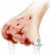 تأثير انحلال العظم والتخلخل العقيم