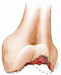 التخطيط لاختيار الغرسة المناسبة