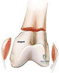 صورة توضيحية لـ استبدال الفخذ البعيد في مراجعة مفصل الركبة الكلي: دليل شامل للمرضى مع الأستاذ الدكتور محمد هطيف