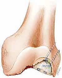 تصنيف فقدان العظم AORI