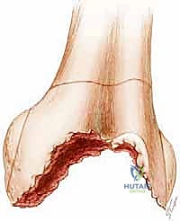 إزالة الغرسة القديمة بحذر