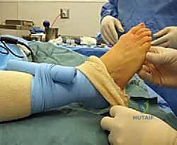 First Metatarsophalangeal (MTP) Joint Arthrodesis: A Masterclass in Hallux Rigidus Reconstruction