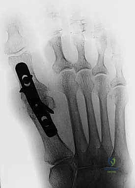 Illustration of arthrodesis of the first - Dr. Mohammed Hutaif