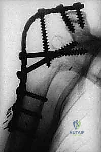 تثبيت مفصل الكتف (Glenohumeral Arthrodesis): حل إنقاذي متقدم لاستعادة وظيفة الذراع بإشراف الأستاذ الدكتور محمد هطيف