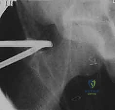 صورة توضيحية لـ منظار الورك: دليلك الشامل لعلاج آلام مفصل الورك المعقدة مع الأستاذ الدكتور محمد هطيف في صنعاء