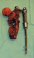 صورة طبية: استئصال عظم الفخذ وإعادة البناء بالطرف الاصطناعي: دليل شامل للمرضى مع الأستاذ الدكتور محمد هطيف في صنعاء