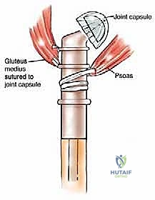 تخطيط جراحي دقيق لحالة استئصال ورم من عظم الفخذ