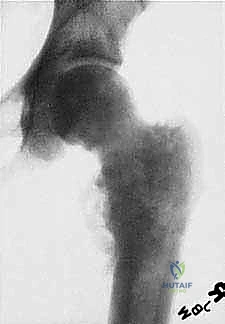 صورة طبية: استئصال عظم الفخذ وإعادة البناء بالطرف الاصطناعي: دليل شامل للمرضى مع الأستاذ الدكتور محمد هطيف في صنعاء