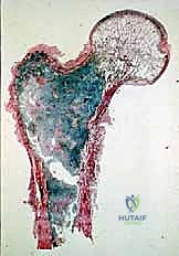 صورة طبية: استئصال عظم الفخذ وإعادة البناء بالطرف الاصطناعي: دليل شامل للمرضى مع الأستاذ الدكتور محمد هطيف في صنعاء