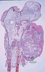 صورة طبية: استئصال عظم الفخذ وإعادة البناء بالطرف الاصطناعي: دليل شامل للمرضى مع الأستاذ الدكتور محمد هطيف في صنعاء