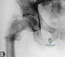 تشريح دقيق لعظم الفخذ والمفاصل المرتبطة به