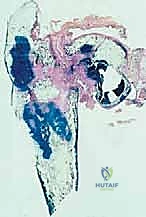 صورة طبية: استئصال عظم الفخذ وإعادة البناء بالطرف الاصطناعي: دليل شامل للمرضى مع الأستاذ الدكتور محمد هطيف في صنعاء